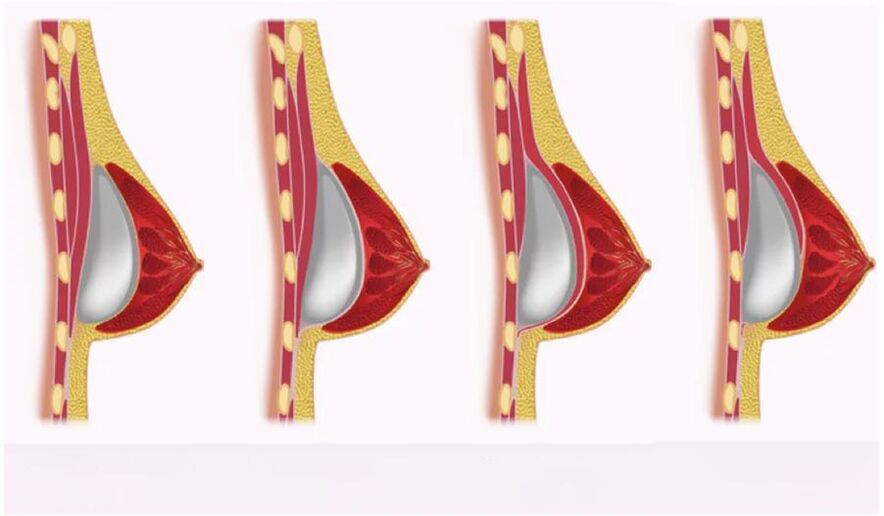 Acceso para instalación de implantes